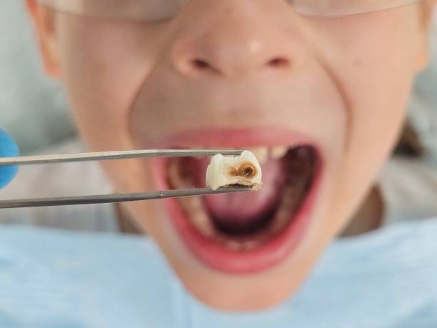 Best Emergency Dentist for Knocked-Out Tooth in Foley, AL